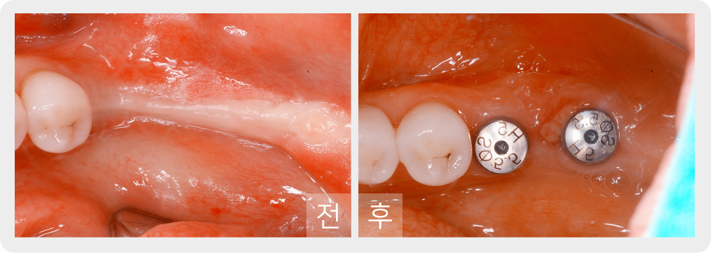 전/후 사진