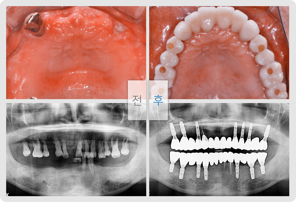 전/후 사진
