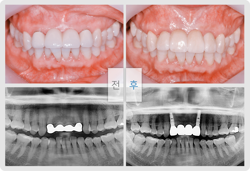 전/후 사진