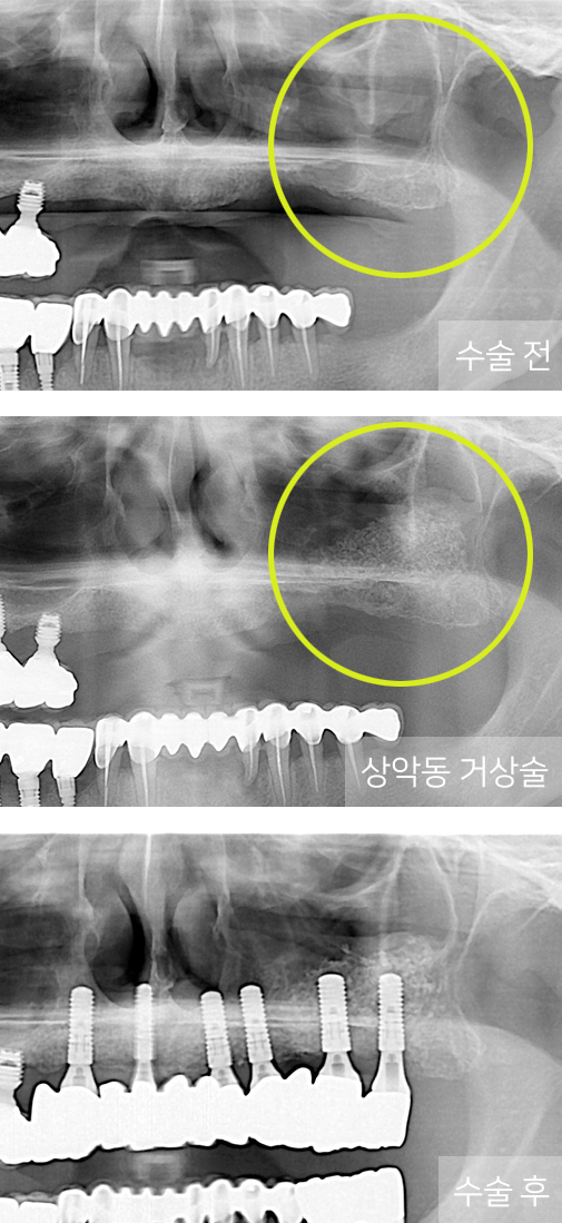 전/후 사진